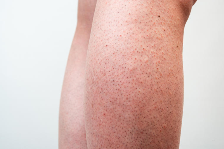 Posledica infekcije ili genetika?Jagodičasta koža na nogama je čest problem, a evo kako se rešava!