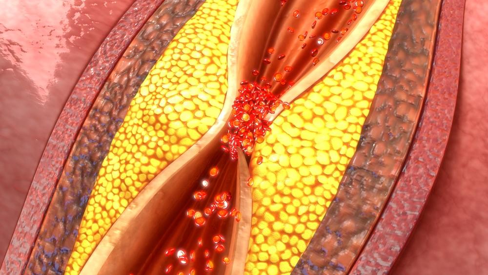 Arterije, Krvni sudovi, začepljene arterije