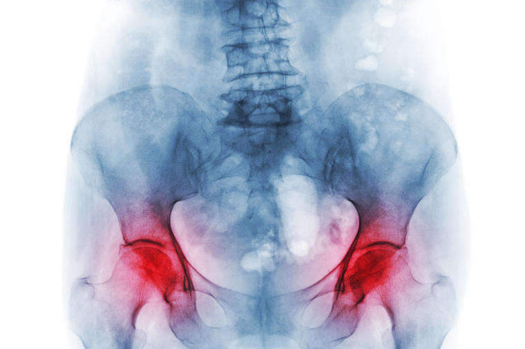 Osteopenija: Kako je saseći u korenu i sprečiti propadanje i krhkost kostiju!
