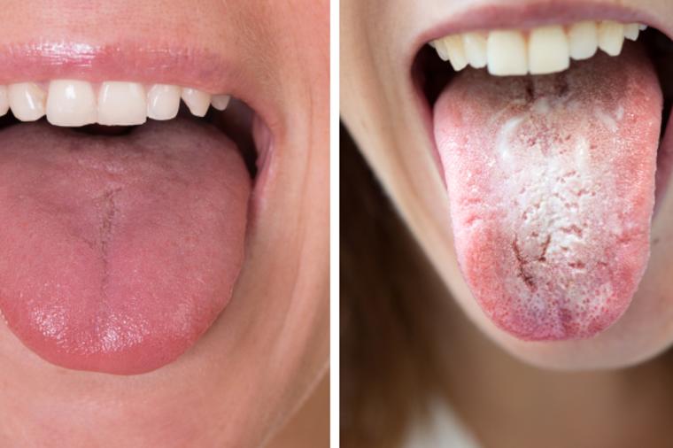 3 stvari koje vam jezik govori o zdravlju vašeg tela: Čist jezik, zdravi unutrašnji organi!