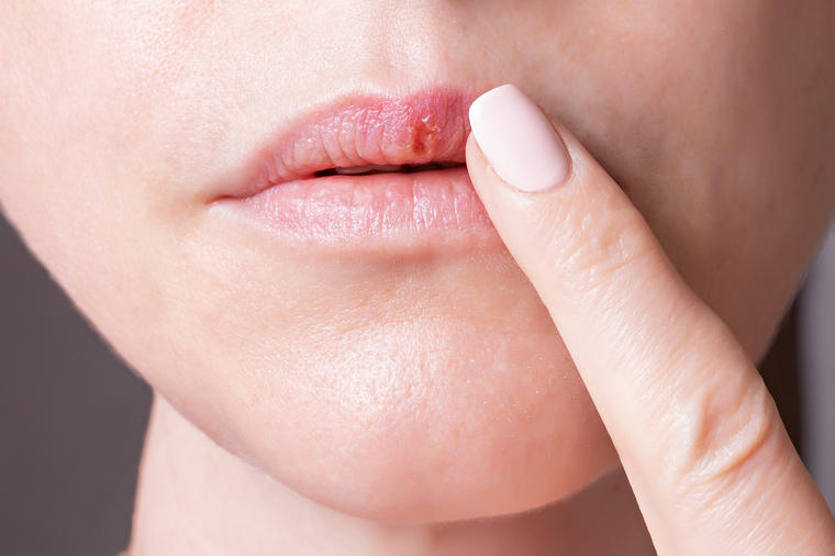Evo kako da se oslobodite herpesa na usnama preko noći: Ovo provereno ublažava upalu!