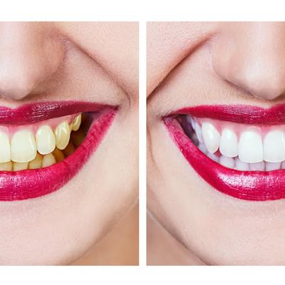 Započnite dan sa osmehom: U rekordnom roku izbelićete zube na ovaj potpuno bezbedan način!