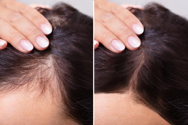 Prerani gubitak kose pogađa milione muškaraca i žena: Evo kako da pobedite u borbi sa ovim stanjem!