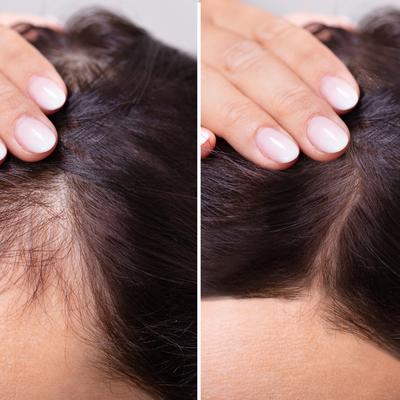 Prerani gubitak kose pogađa milione muškaraca i žena: Evo kako da pobedite u borbi sa ovim stanjem!