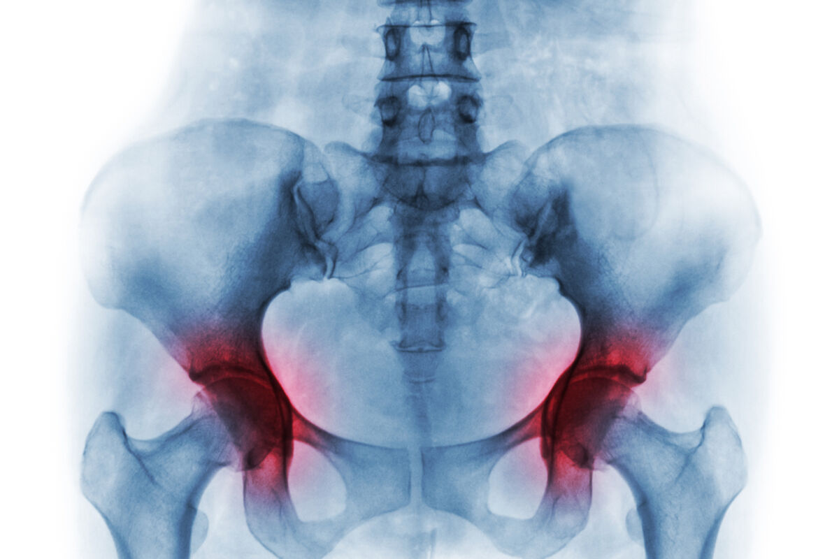 keton za bolove u kuku akupunkturno liječenje artroze koljena