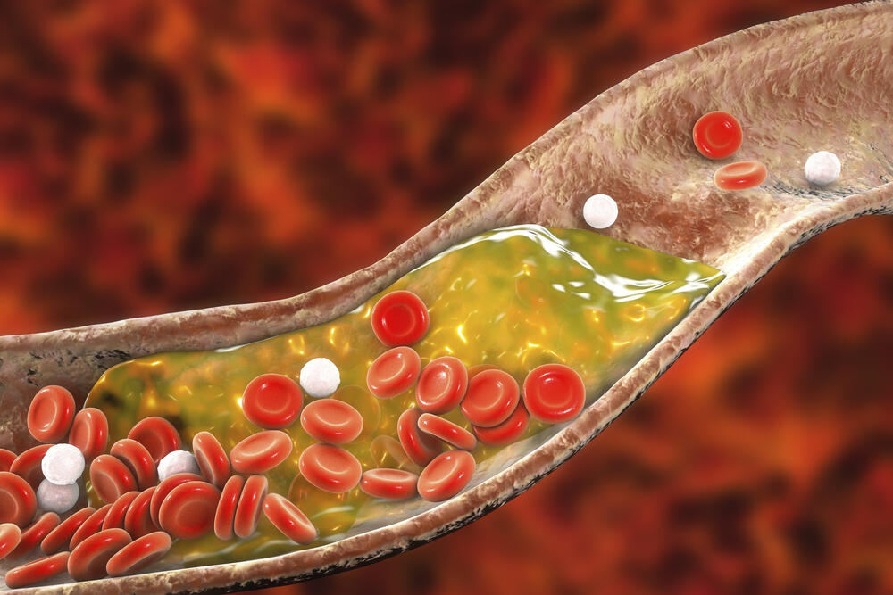 Holesterol, Arterije, Masnoće u krvi