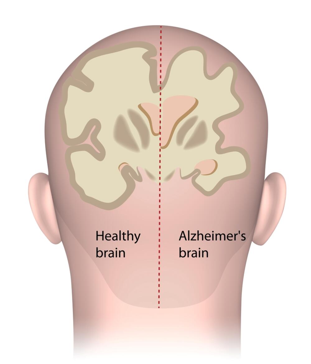 Prikaz zdravog mozda (levo) i prikaz mozga obolelog od Alchajmerove bolesti (desno)