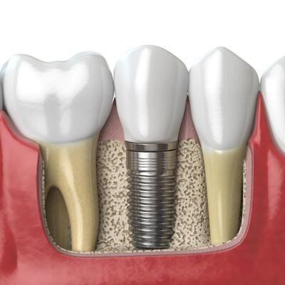 Sve što vas zanima o zubnim implantima!