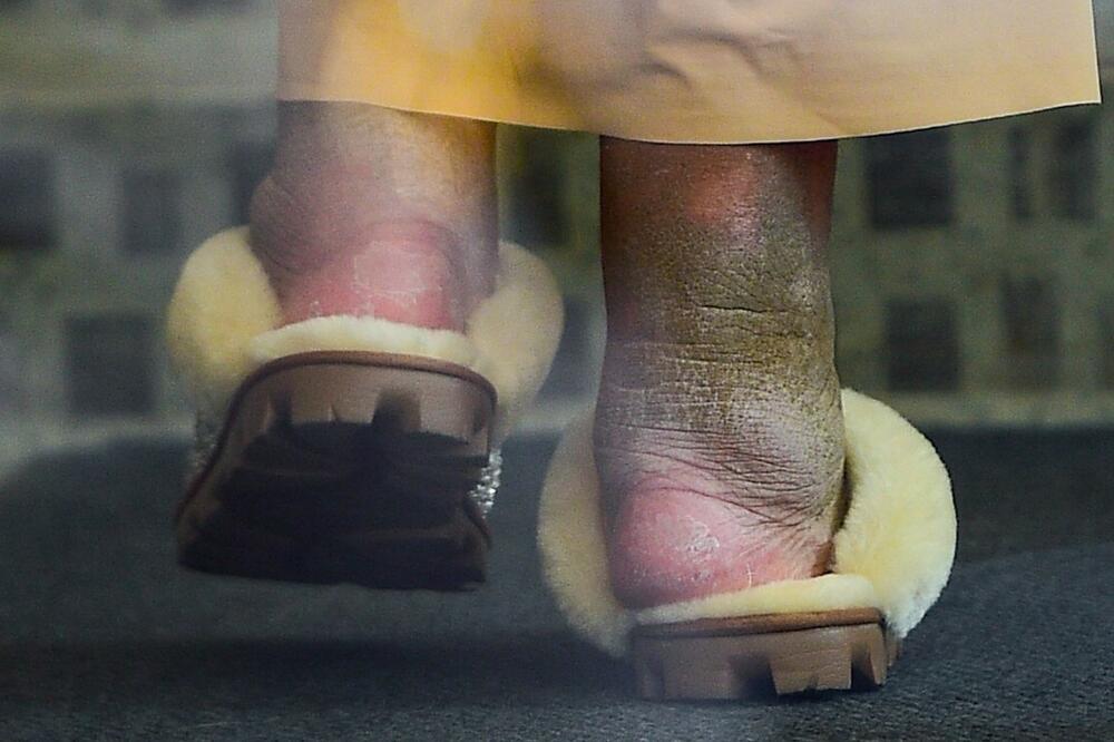 Vendi Vilijams boluje od limfedema zbog kojeg su joj stopala 'pozelenala'  
