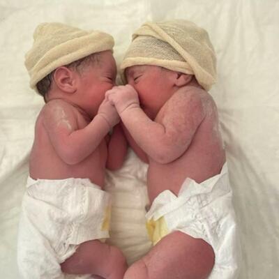 ČUDESNI "POROĐAJ SIRENE" DEŠAVA SE JEDNOM U 80.000 SLUČAJEVA: Ovi neverovatni blizanci iznenadili su medicinsko osoblje