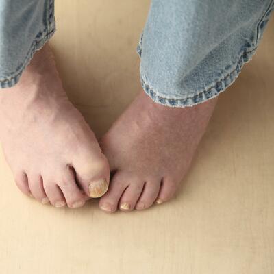 KAKO DA SE REŠITE GLJIVICA: Ne skrivajte vaša stopala, mogu da budu lepa i zdrava ovog leta - evo kako!
